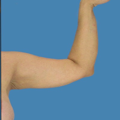 Arm Lift Before & After Patient #898