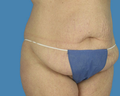 LipoTuck Before & After Patient #1003