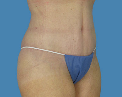 LipoTuck Before & After Patient #1003