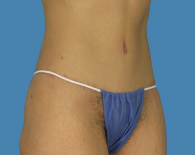 LipoTuck Before & After Patient #1004