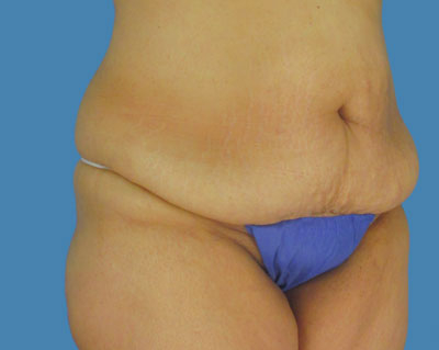 LipoTuck Before & After Patient #1005
