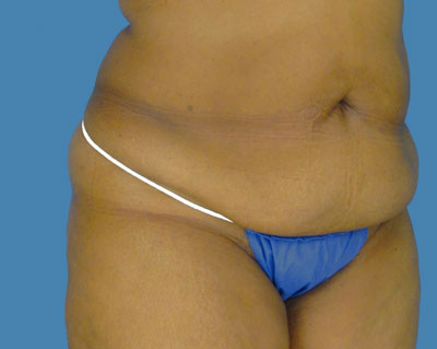 LipoTuck Before & After Patient #1006