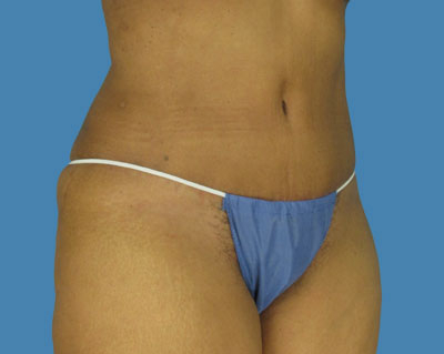 LipoTuck Before & After Patient #1006