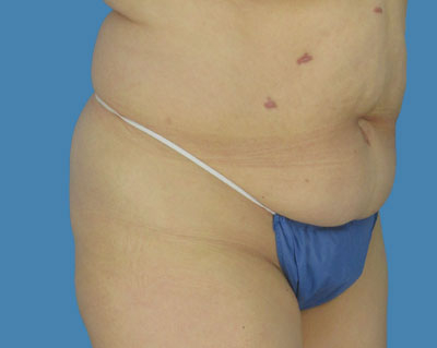 LipoTuck Before & After Patient #1007