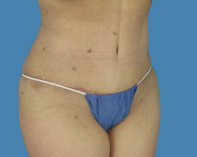LipoTuck Before & After Patient #1007
