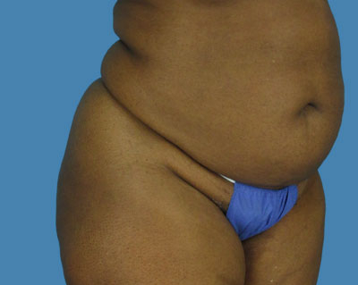 LipoTuck Before & After Patient #1008