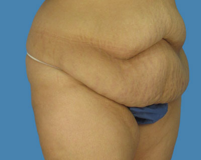 LipoTuck Before & After Patient #1009