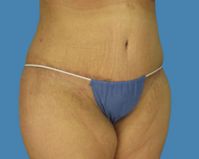 LipoTuck Before & After Patient #1009