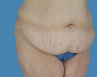 Lipotuck Before & After Patient #1049