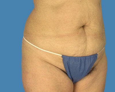 LipoTuck Before & After Patient #1051