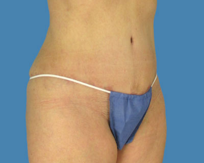 LipoTuck Before & After Patient #1053