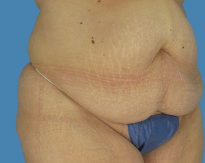 LipoTuck Before & After Patient #1069