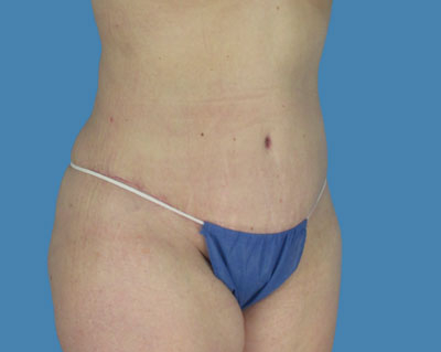LipoTuck Before & After Patient #1055