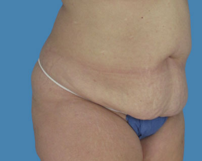 LipoTuck Before & After Patient #1057