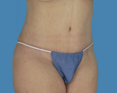 LipoTuck Before & After Patient #1057
