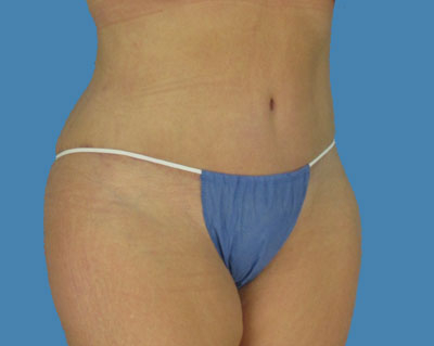 LipoTuck Before & After Patient #1059