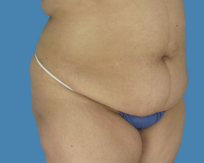 LipoTuck Before & After Patient #1070