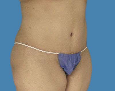 LipoTuck Before & After Patient #1070
