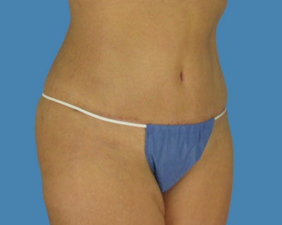 Lipotuck Before & After Patient #1071