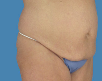 LipoTuck Before & After Patient #1072