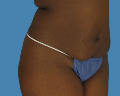 LipoTuck Before & After Patient #1073