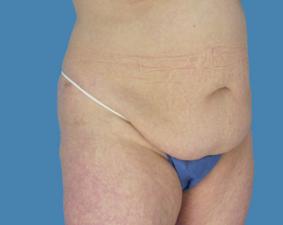 LipoTuck Before & After Patient #1074
