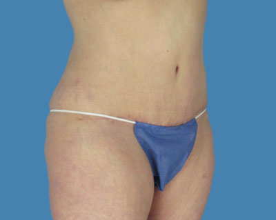 LipoTuck Before & After Patient #1074