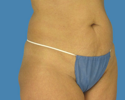 LipoTuck Before & After Patient #1075