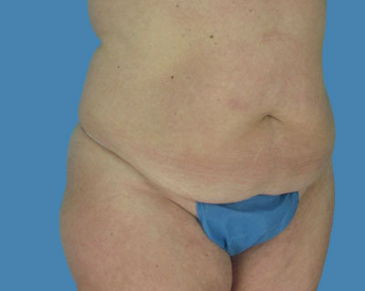 LipoTuck Before & After Patient #1076