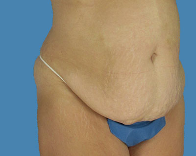 LipoTuck Before & After Patient #1077