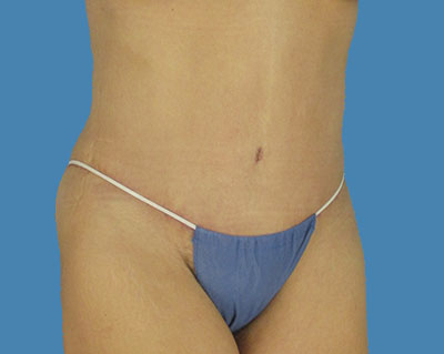 LipoTuck Before & After Patient #1077