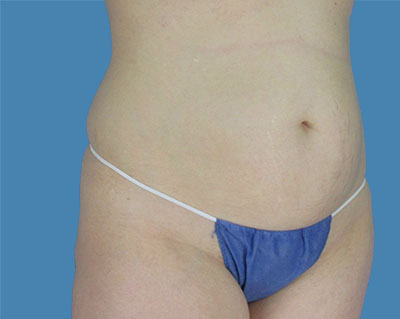 LipoTuck Before & After Patient #1079
