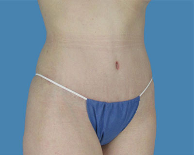 LipoTuck Before & After Patient #1079