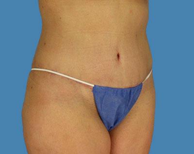 LipoTuck Before & After Patient #1078