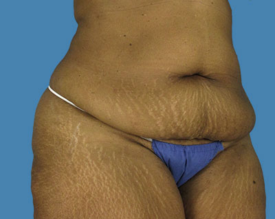 Tummy Tuck Before & After Patient #1080