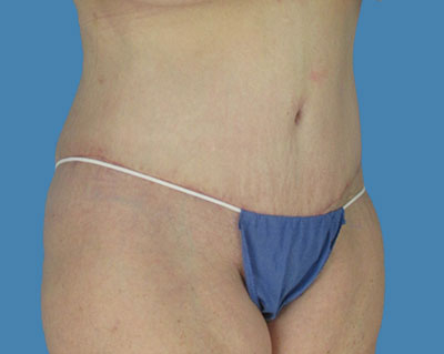 LipoTuck Before & After Patient #1081