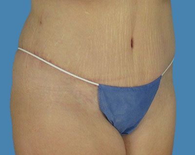 LipoTuck Before & After Patient #1120