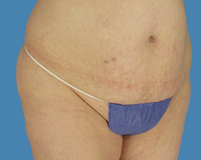 LipoTuck Before & After Patient #1121