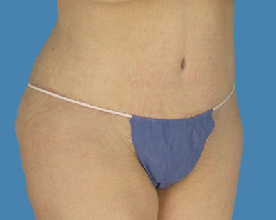 LipoTuck Before & After Patient #1121