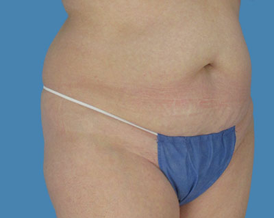 LipoTuck Before & After Patient #1122