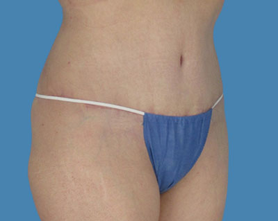 LipoTuck Before & After Patient #1122