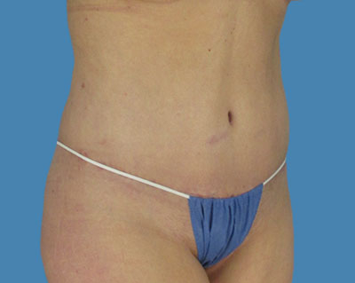 LipoTuck Before & After Patient #1123
