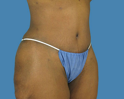LipoTuck Before & After Patient #1024