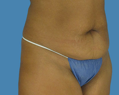 Tummy Tuck Before & After Patient #1124