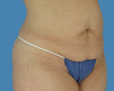 LipoTuck Before & After Patient #1125