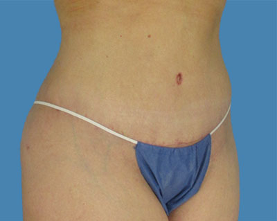 LipoTuck Before & After Patient #1125