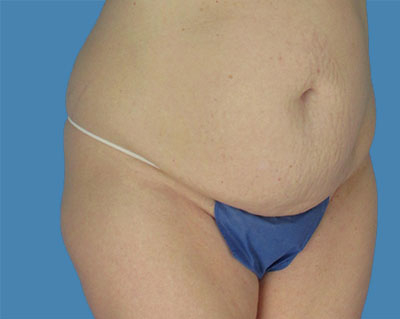 LipoTuck Before & After Patient #1131