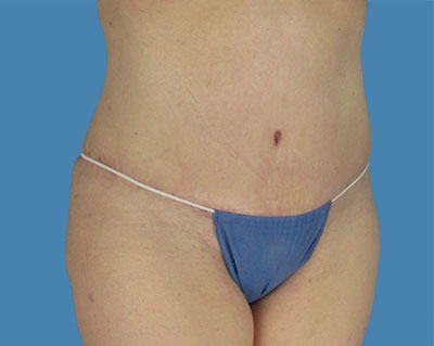 LipoTuck Before & After Patient #1131