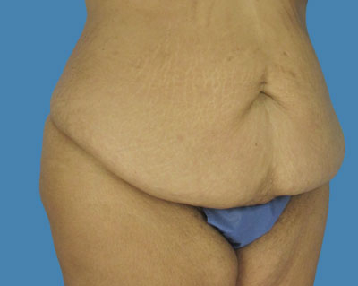 LipoTuck Before & After Patient #1132