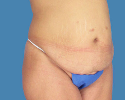 LipoTuck Before & After Patient #1133